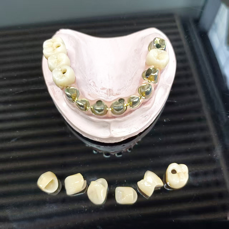 Full‑Arch Metal‑Ceramic Bridge (PFM Full Arch Prosthesis)